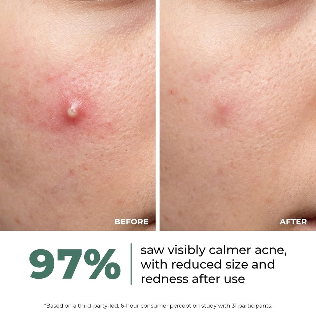 Rapid Relief Acne Spot Corrector Gel (15g)| Triple-Action Treatment For Men & Women