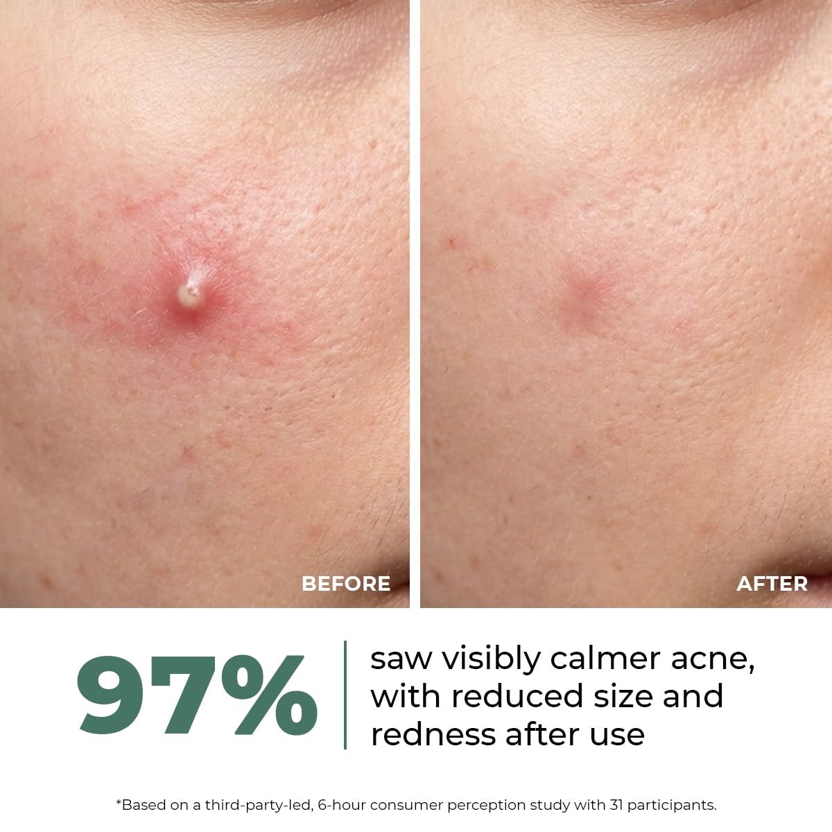 Rapid Relief Acne Spot Corrector Gel (15g)| Triple-Action Treatment For Men & Women